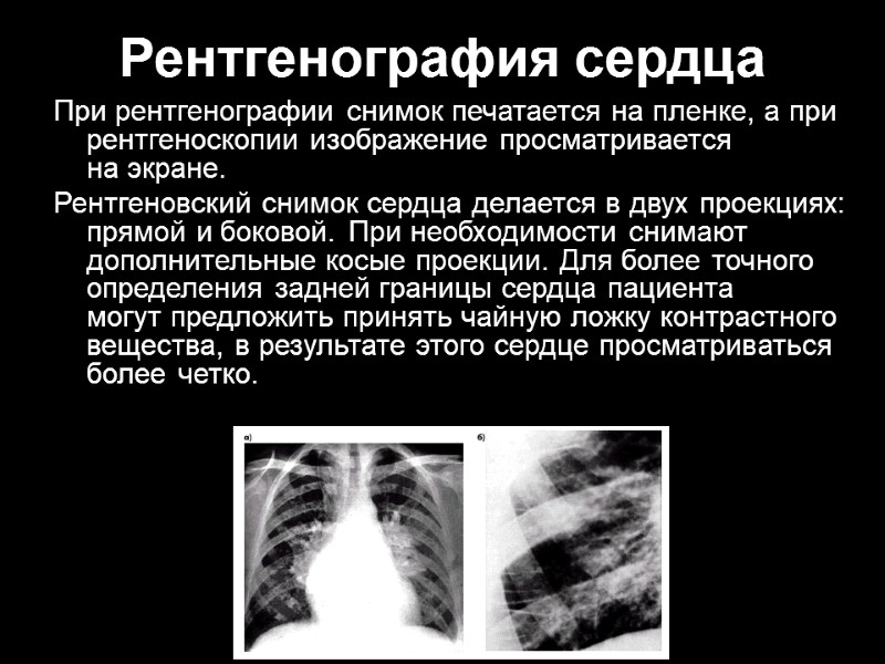Рентгенография сердца При рентгенографии снимок печатается на пленке, а при рентгеноскопии изображение просматривается на